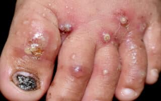 Lesioni cutanee malattia acaro della scabbia Lesioni cutanee malattia acaro della scabbia