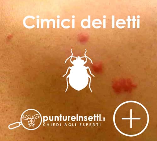 Puntura di cimice dei letti in primo piano