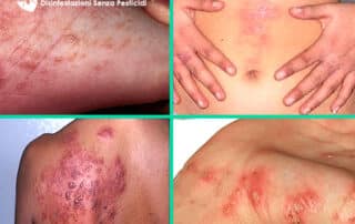 Lesioni bolle da malattia della scabbia Lesioni bolle da malattia della scabbia