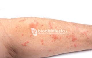 Riconoscere i sintomi della malattia della scabbia Riconoscere i sintomi della malattia della scabbia