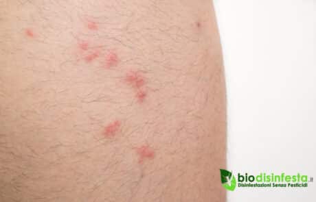 Punture delle pulci come riconoscerle