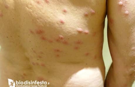 Sintomi identificare punture acaro del tarlo