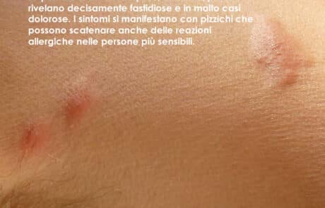 Come riconoscere le punture dell'acaro del tarlo pyemotes