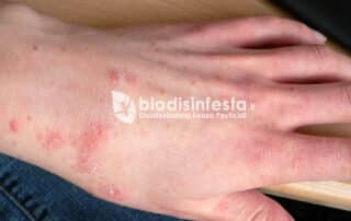 Sintomi e contagio malattia della scabbia cause e rimedi contro il sarcpotes scabiei Sintomi e contagio malattia della scabbia cause e rimedi contro il sarcpotes scabiei