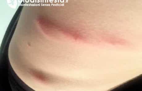 Sintomi e punture acaro del tarlo