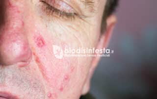 Sintomi malattia della scabbia causa e rimedi Sintomi malattia della scabbia causa e rimedi
