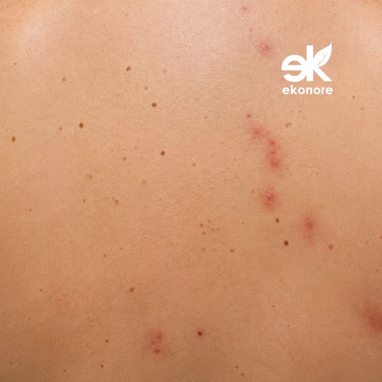 punture scleroderma domesticus 1 punture scleroderma domesticus 1