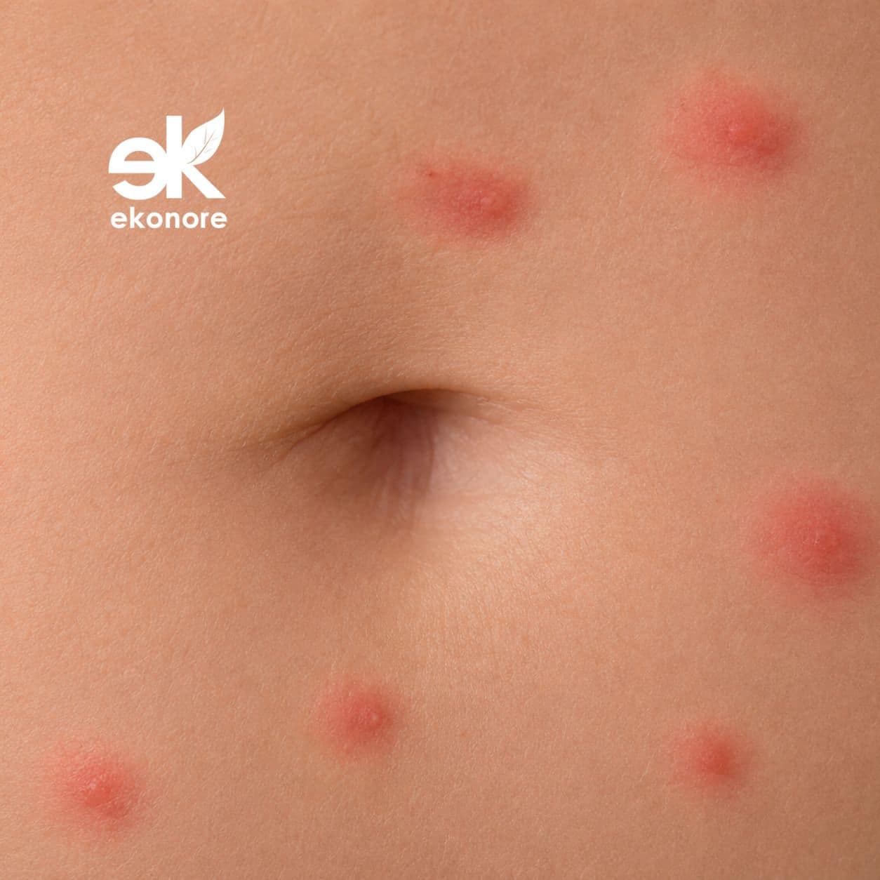 punture scleroderma domesticus 4 punture scleroderma domesticus 4