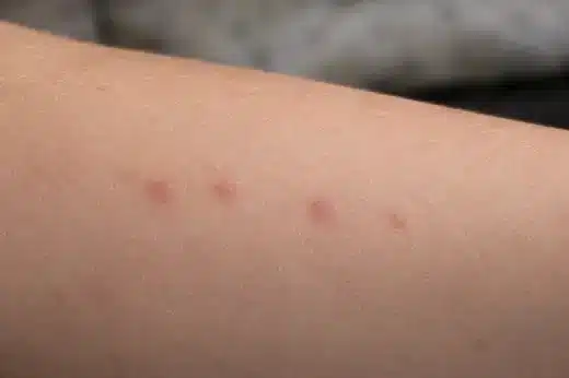 Punture di cimici dei letti allineate sulla pelle