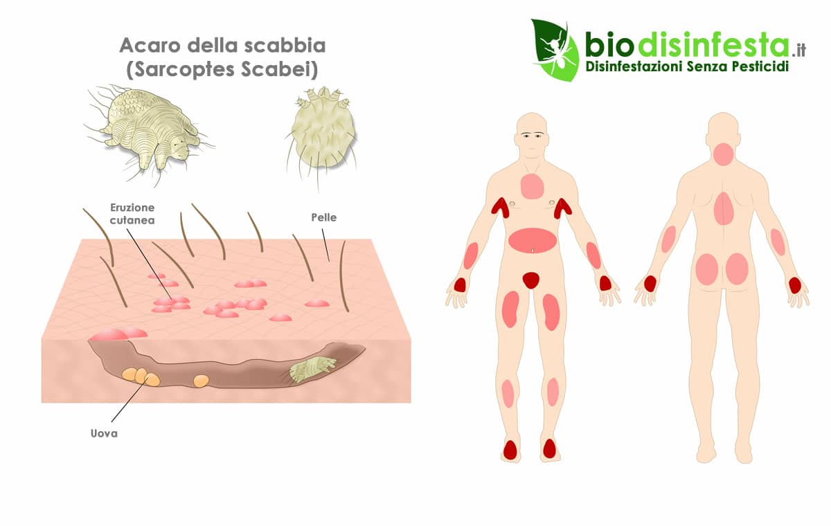 Come si prende la malattia dell'acaro della scabbia