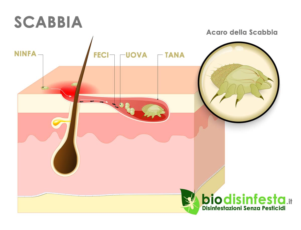 Malattia della scabbia come si prende Malattia della scabbia come si prende