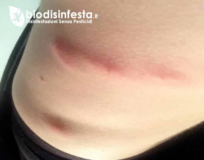 Sintomi e punture acaro del tarlo Sintomi punture acaro del tarlo pyemotes